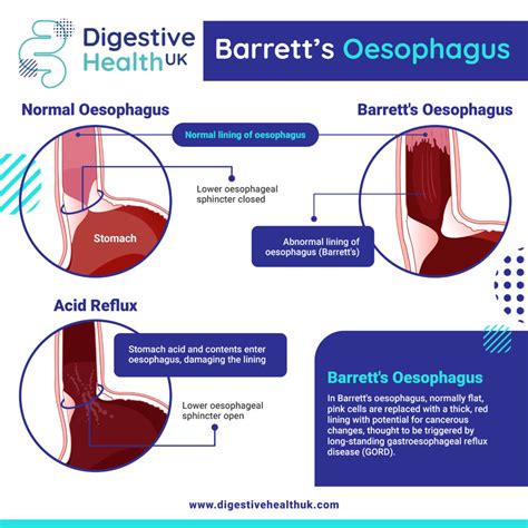 Barretts Oesophagus Vs Acid Reflux What Are The Symptoms Digestive