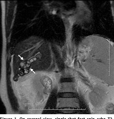 Figure 1 From Magnetic Resonance Imaging Of A Liver Hydatid Cyst