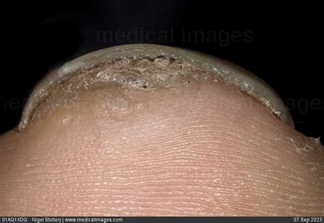 Stock Image Dermatology Subungual Viral Wart Whitening Of The Great