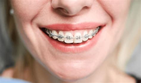 Advantages And Disadvantages Of Metal Braces Grant Orthodontics