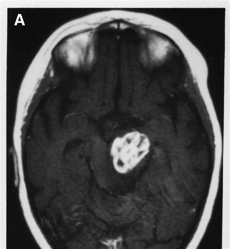Contrast Enhanced Mri Scan Of The Brain Of A 6 Year Old Female With Gbm