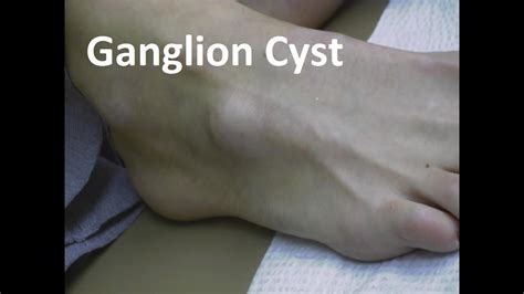 Ganglion Cyst Foot Surgery Blackninedesigns