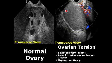 Ovary Ultrasound Normal Vs Abnormal Image Appearances Ovarian