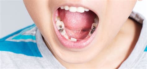Wann müssen Milchzähne vom Zahnarzt gezogen werden 360milchzahn