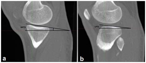 Cureus Posterior Tibial Slope And A New Morphometric Method With Free