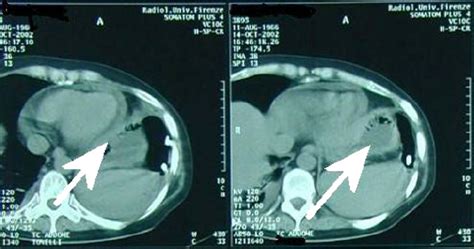 Ct Showing A Mild Pericardial Effusion Pleural Effusion And Left