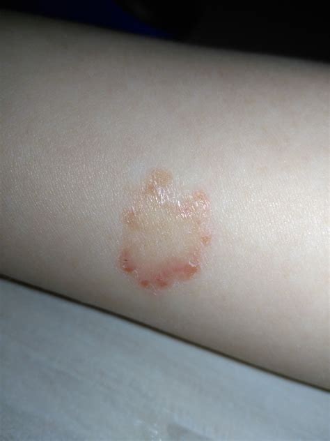 Красное пятно у ребенка на руке Вопрос дерматологу 03 Онлайн