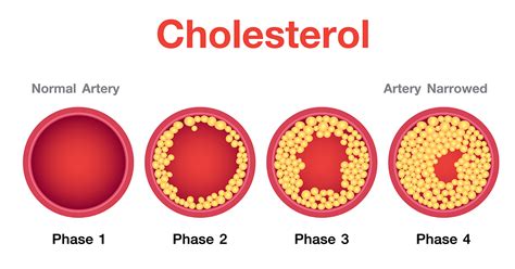 High Cholesterol Levels Functional Medical Corporation