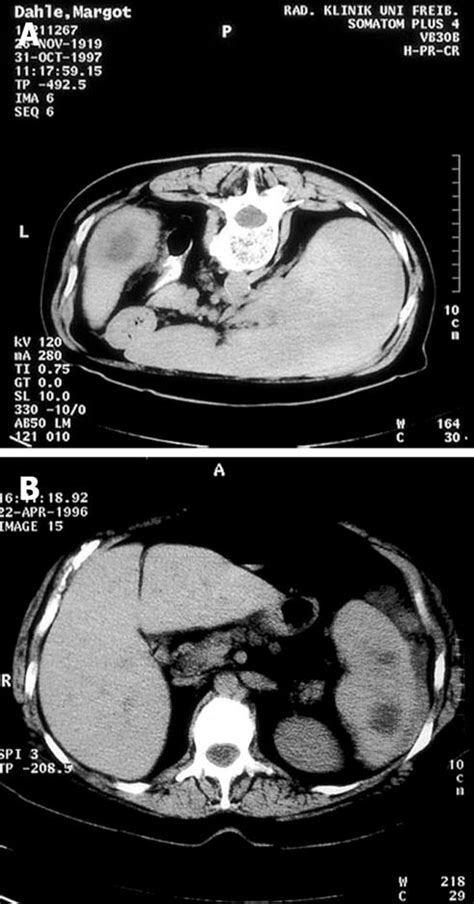 Abscesses Of The Spleen Report Of Three Cases
