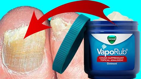 How To Use Vicks To Treat Cure Toenail Fungus FAST EASY REMEDY Epic Natural Health