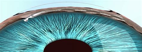 Hydrus Minimally Invasive Glaucoma Surgery Migs Cfs