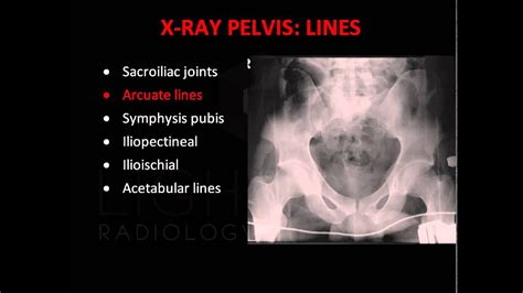 Emergency X Ray Interpretation Of The Pelvis Youtube