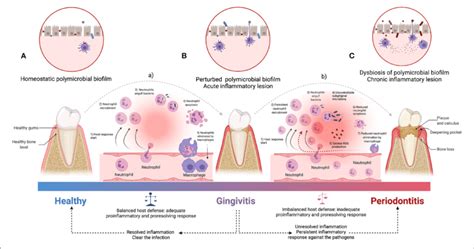 An Overview Of The Pathogenesis Of Periodontitis The Acute