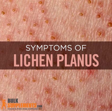 Lichen Planus Symptoms Causes And Treatment