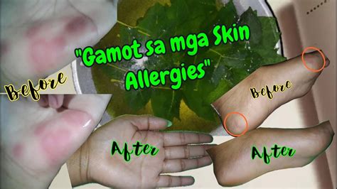 Mabisang Gamot Sa Skin Allergies Galis Kagaw At Sobrang Pangangati
