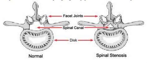 Lumbar Spinal Stenosis Boston Medical Center