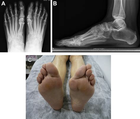 Management Of Complications After Hallux Valgus Reconstruction Foot