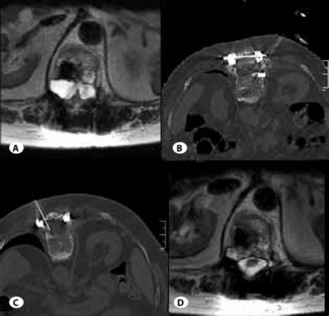 A Axial T2 Weighted Mr Image Shows Two Cystic Lesion Located On Corpus