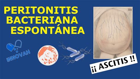 Peritonitis Bacteriana Espont Nea C Mo Diagnosticarla Y Tratarla
