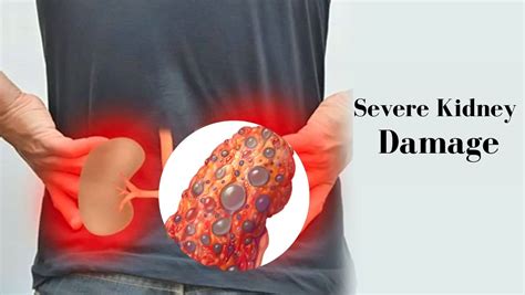 Severe Gall Bladder Infection Can Damage Your Kidneys Completely