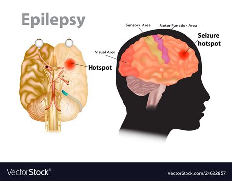 Medical A Brain With Epilepsy Royalty Free Vector Image