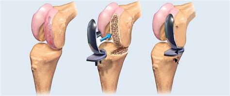 How To Choose An Orthopedic Surgeon For Knee Replacement Surgery