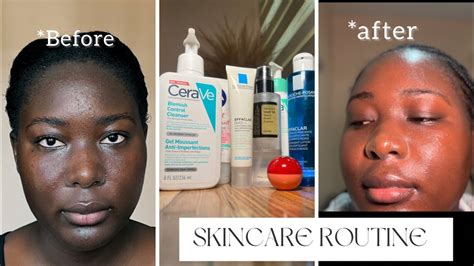 How I Cleared My Skin How To Get Rid Of Acne And Dark Spots Part 2