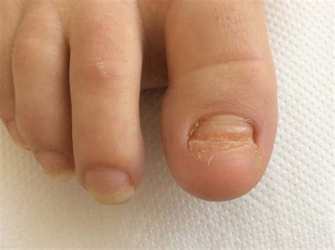 Toe Nail Reconstruction Prosthetic Toe Nail