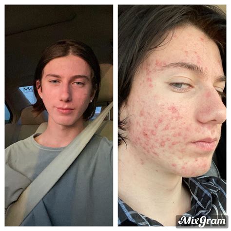 4 Months On Accutane Before And After Raccutane