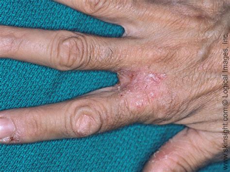 Contact Dermatitis National Eczema Association