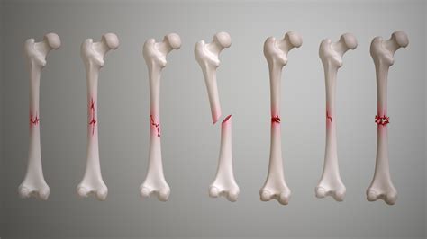 Bone Fracture Fi Scientific Animations