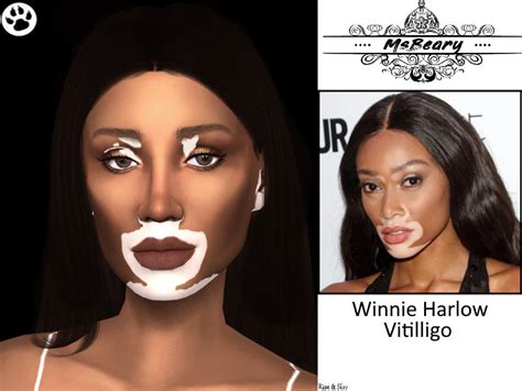 Msbearys Winnie Harlow Vitiligo Skin Pattern