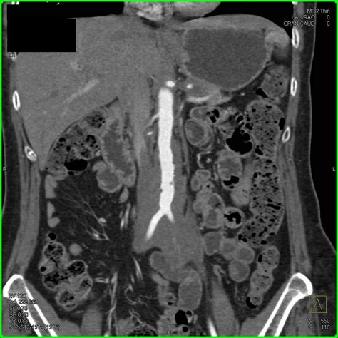 Retroperitoneal Fibrosis With Obstructed Left Kidney Genitourinary