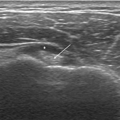Sonographic Finding Of A Long Head Of The Biceps Tendon Download
