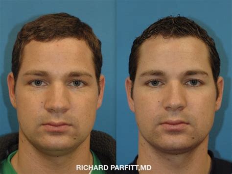 Male Plastic Surgery Before And After Photos