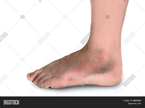 Woman Broken Foot Image And Photo Free Trial Bigstock