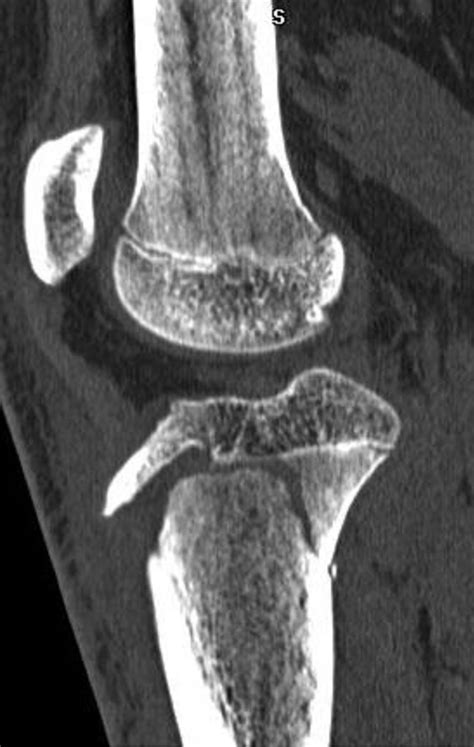 Tibial Tuberosity Avulsion Fracture Hot Sex Picture
