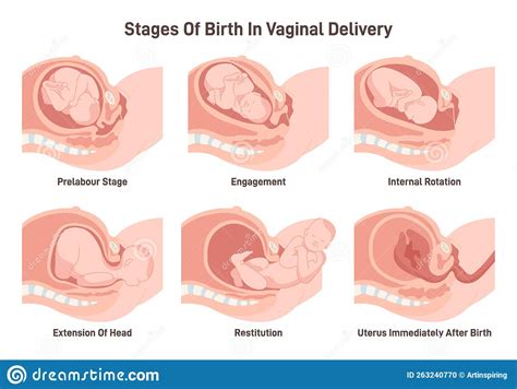 Stages Of Baby Birth In Vaginal Delivery Fetus Movement During The