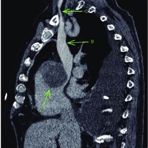 Admission Computed Tomography Chestabdomenpelvis Sagittal View