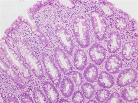 Microscopic Colitis Occurring In Association With Hyperplastic Polyps