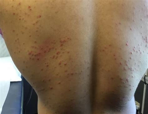 Derm Dx Dermatitis On The Torso Of A Baseball Player Dermatology Advisor