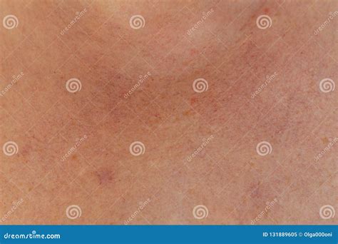 Human Skin With Redness And Red Capillaries Stock Image Image Of