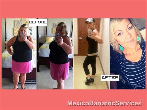 weight loss surgery success stories mexico bariatric services