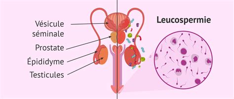 Infection Dans Lappareil Génital Masculin