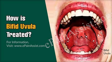 Bifid Uvula Causes Treatment Complications