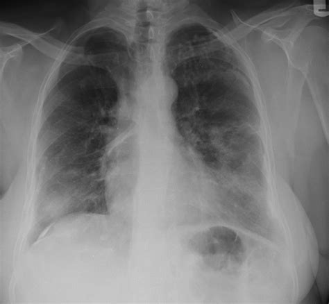 Asbestosis And Cryptococcosis Pleural Plaque X Ray Cas Flickr