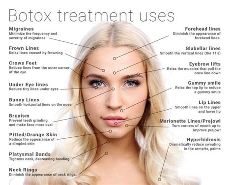 Image Result For Botox Injection Sites Chart Botox Face Botox