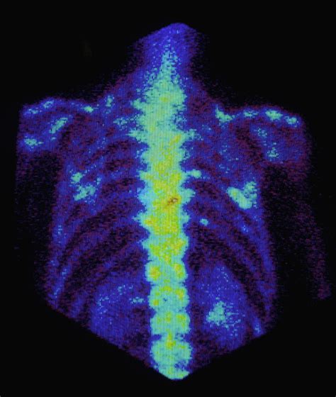 Fcol Gamma Scan Of Metastatic Bone Cancer In Ribs Photograph By Chris