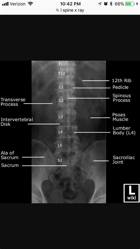 Normal Lumbosacral X Ray Lateral Lumbar Radiographs Left