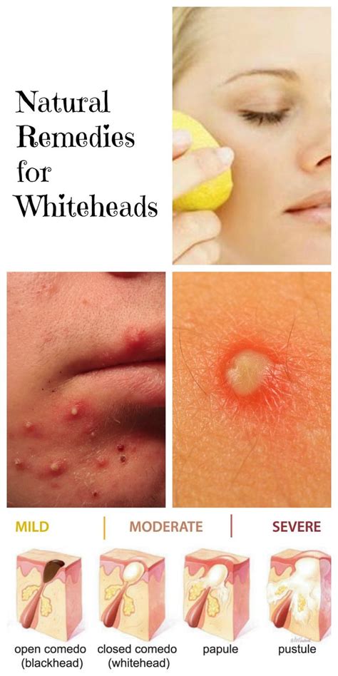 How To Remove Whiteheads How Get Rid Of Whiteheads Naturally Style